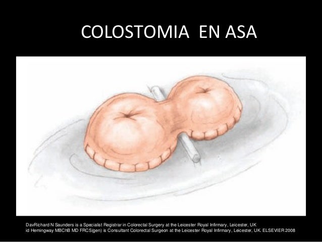 colostomia en asa